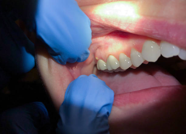 Best Urgent Care for Lost Fillings or Crowns in Kentland, IN